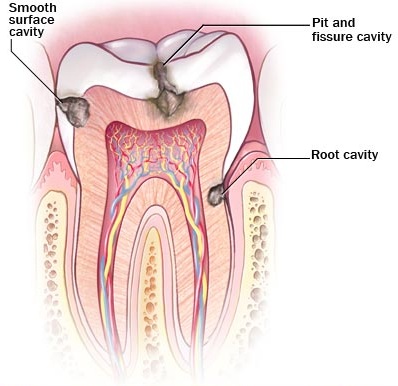 dental fillings