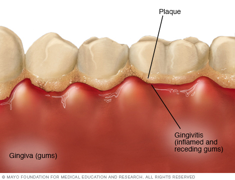 Dental Cleaning and Prevention